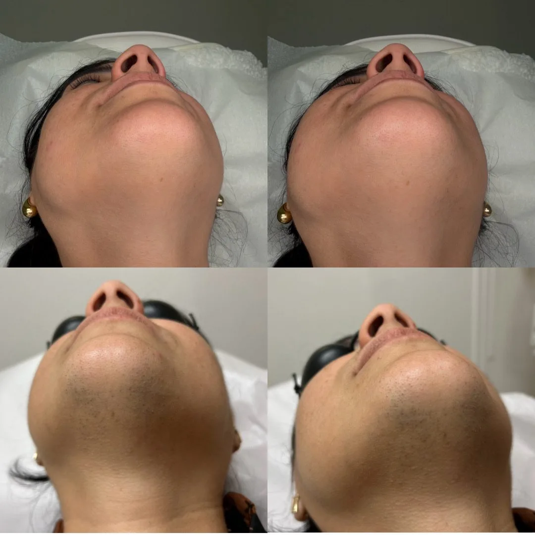 Antes y después de tratamiento para melasma