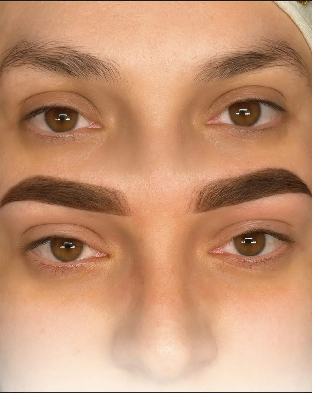 Antes y después de tratamiento para acné