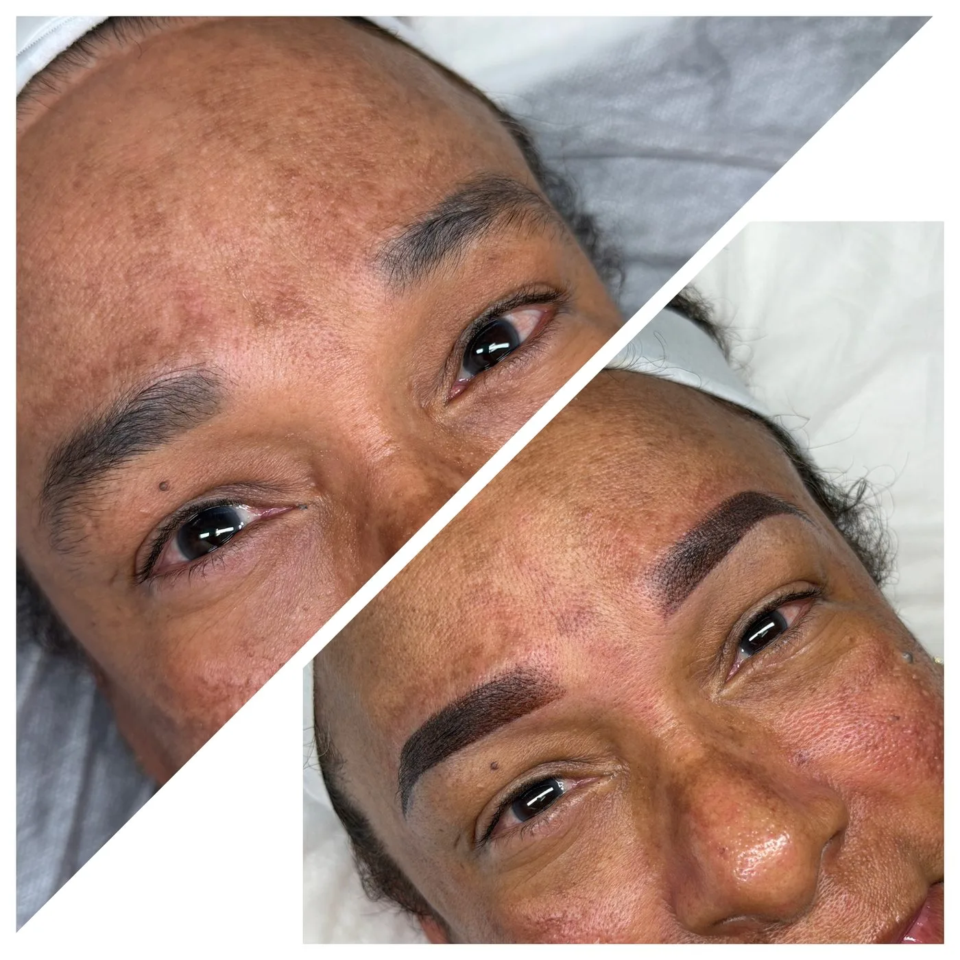 Antes y después de rejuvenecimiento facial