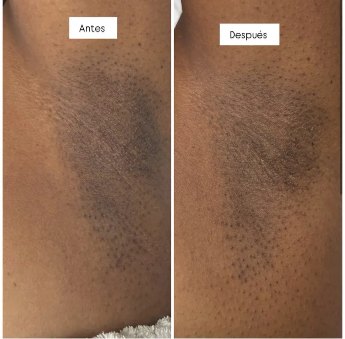 Antes y después de tratamiento para hiperpigmentación